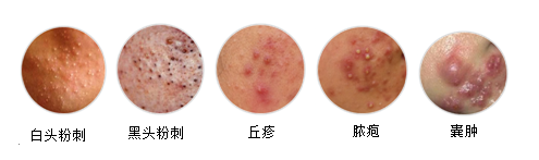 d:\我的文档\桌面\痤疮.png
